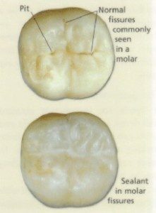 dental-bonding-sealant
