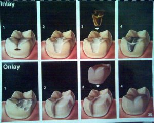 inlays-and-onlays