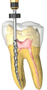 root-canal