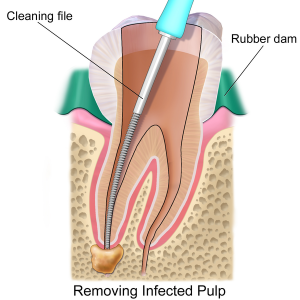 rootcanal2