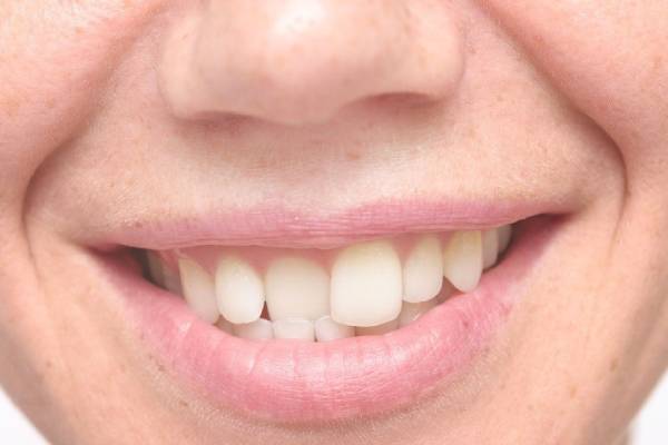 A Crooked Teeth Condition Can Affect a Lot of Areas in One’s Health