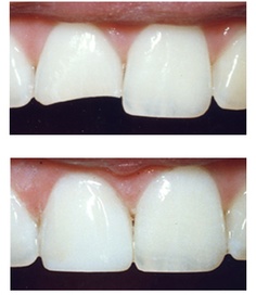 Dental Bonding Cost - Cosmetic Bonding Treatment