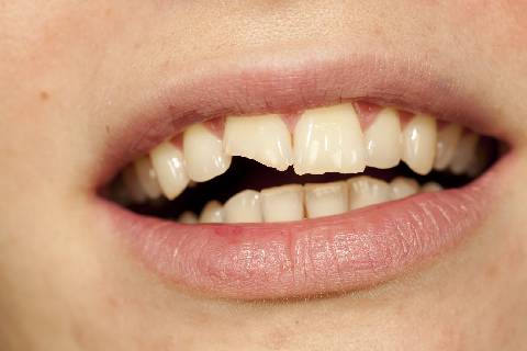 A Chipped Tooth Is Not Hopeless. Get to Know Three Dental Solutions