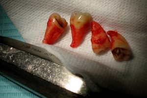 dental-extraction
