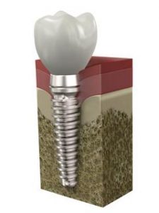 Dental implant