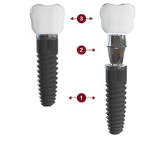 dental-implants-41