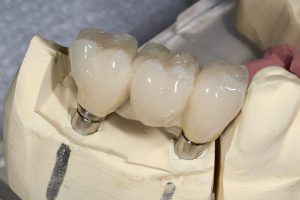 Full Mouth Dental Reconstruction in Atlanta, GA