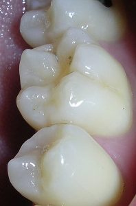 dental-sealants1