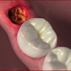 dry sockets in teeth