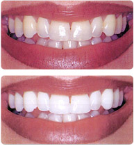 Teeth Whitening Services in Atlanta, GA