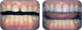 Improve Your Teeth Appearance with Dental Veneers in Atlanta, GA