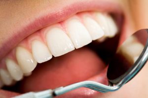 Close-up of patients open mouth before oral checkup with mirror near by