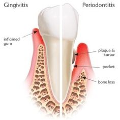 gingival-21