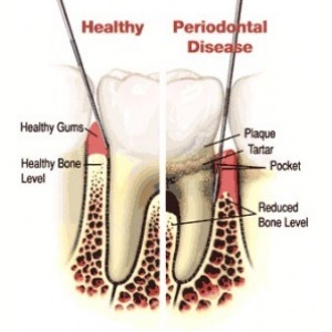 gum-disease