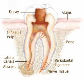 rootcanal