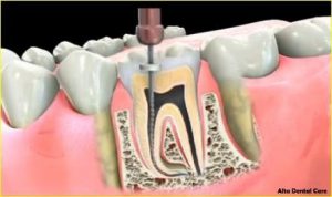 rootcanal3