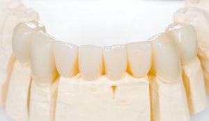 Replace One or More Missing Teeth with Dental Bridges in Atlanta, GA