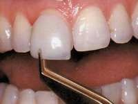 veneers11