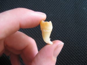 wisdom-tooth-3